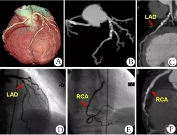 解析冠脉CTA技术检查要点及影像
